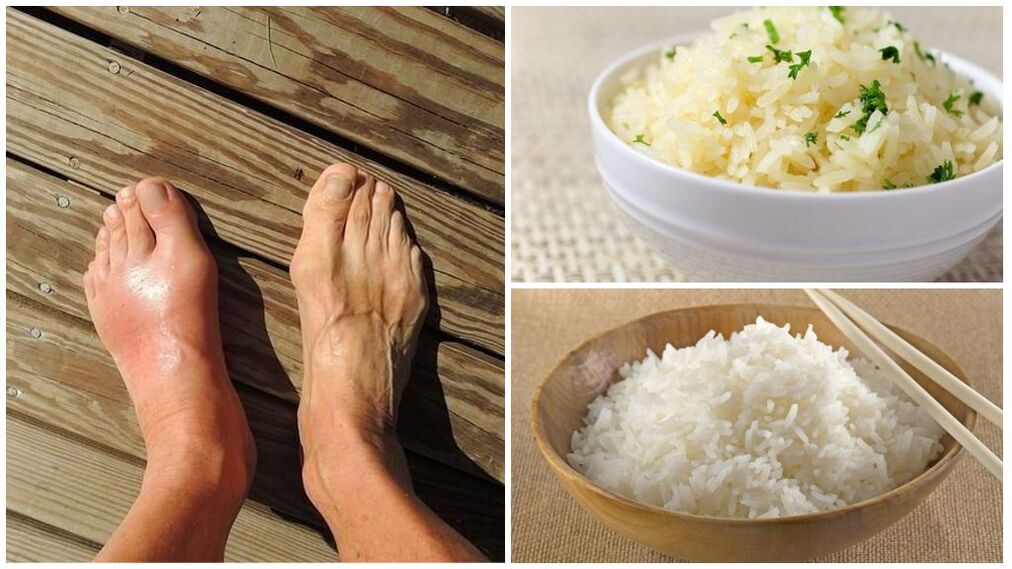 يوصى باتباع نظام غذائي يعتمد على الأرز لمن يعانون من النقرس. 